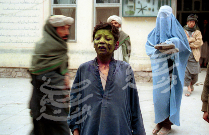 Herat, Afghanistan: a woman shows the burn marks she suffered from an explosion